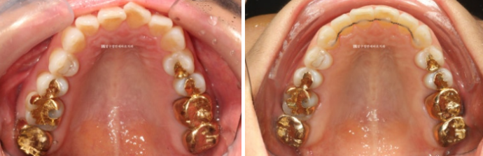 40대 후반 치아교정 해도 될까요? 관련 이미지 7