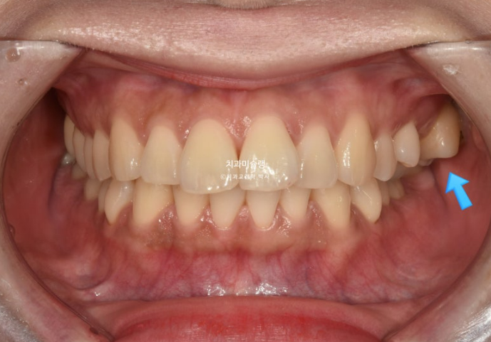 비발치 돌출입 인비절라인 교정 가위교합 중심선 맞추기 관련 이미지 2