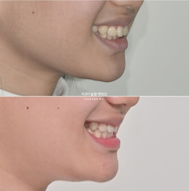 덧니 돌출입 발치교정 상악만 2개 편악 발치 클리피씨 입술부전증 치료 관련 이미지 17