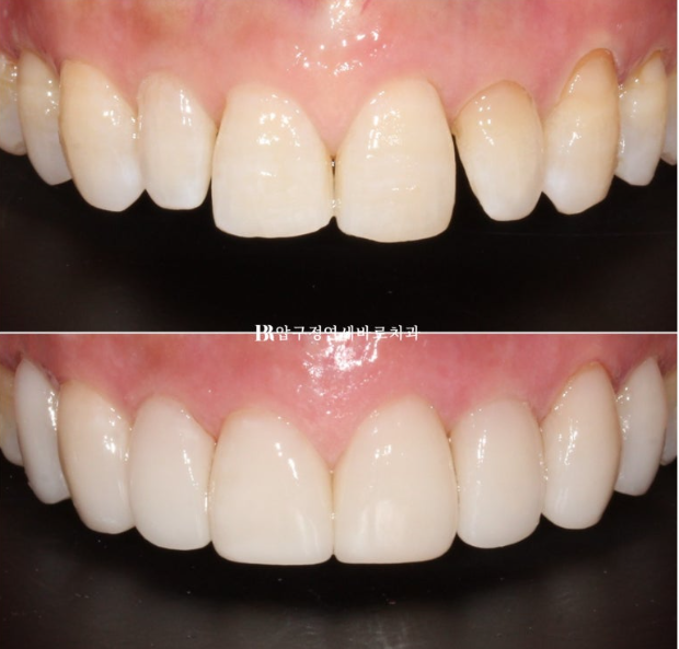 50s Invisalign Lite No-Prep Laminate Bunny Teeth image 12