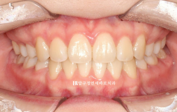 돌출입 교정 후 입매 변화, 과하지 않게 자연스럽게 관련 이미지 12