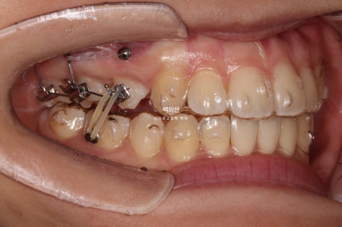 돌출입 교정 인비절라인 발치 교정 개방교합 치료 후기 관련 이미지 12