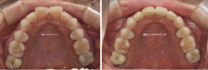 50대 치아교정 인비절라인 라이트 앞니교정 치료 후기 관련 이미지 11