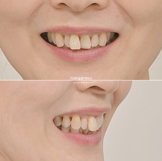 50대 치아교정 중년 발치교정 블랙트라이앵글 치료 후기 관련 이미지 7