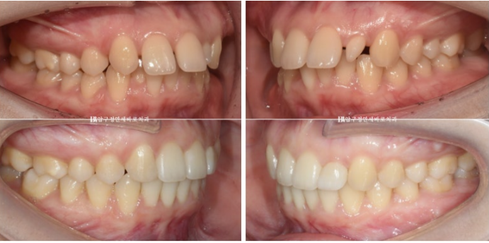 Actual Case of Treating Congenitally Missing and Peg-Shaped Teeth Without Implants image 13
