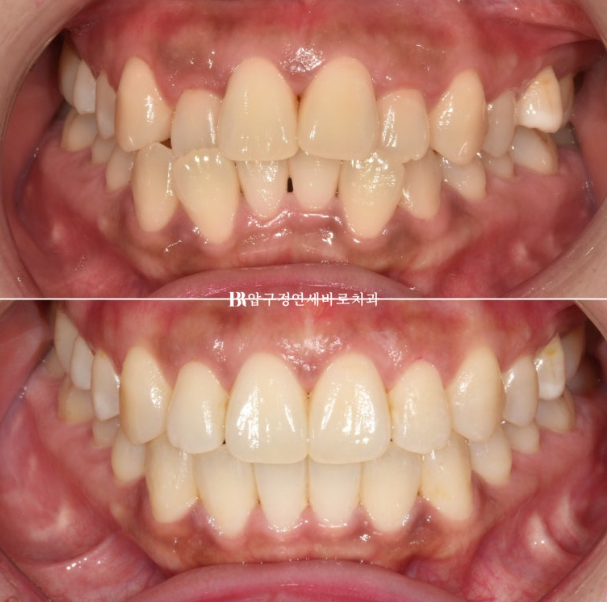 Is compliance important for Invisalign? | A real case that improved reverse bite and scissors bite in 8 months image 1