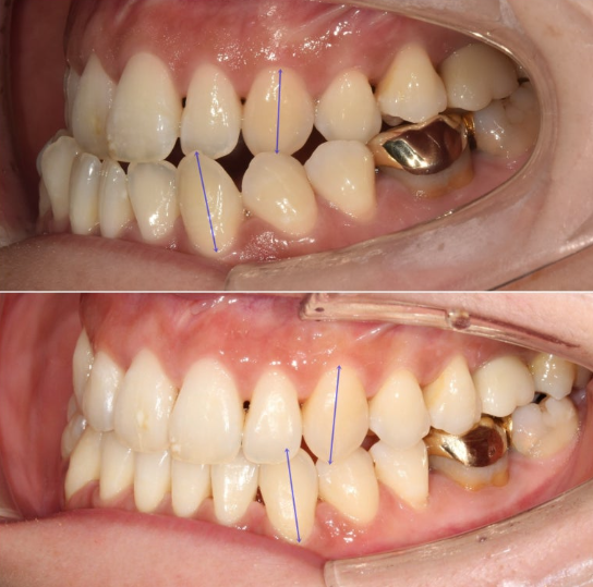 30대 비수술 비발치 주걱턱 부정교합 인비절라인 교정 관련 이미지 1