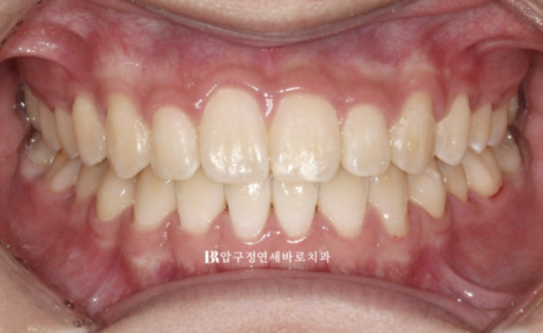 옥니교정 / 웃을때 아랫니만 보여요. 앞니 노출도 교정? 관련 이미지 7