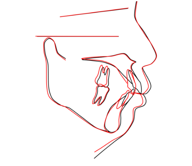 40대 치아교정 가능할까요? 치주염 있어도 치아교정 가능할까요? 임플란트 없이 교정하기 관련 이미지 15