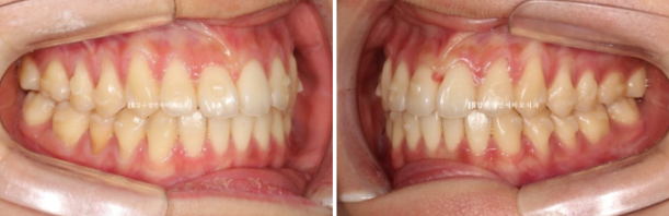 인비절라인 익스프레스 토끼이빨 교정 기간? 인비절라인 종류는? 관련 이미지 7