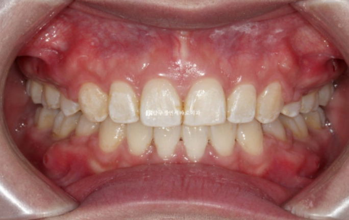 How Do the Buccal Corridors and Smile Line Change After Extraction Treatment for Protruding Teeth?|An Orthodontic Case That Also Improved Lip Incompetence image 9
