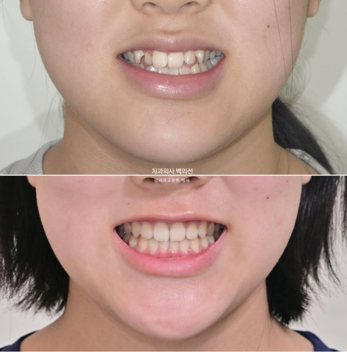 중학생 주걱턱 반대교합 개방교합 덧니 교정 인비절라인 후기 관련 이미지 12