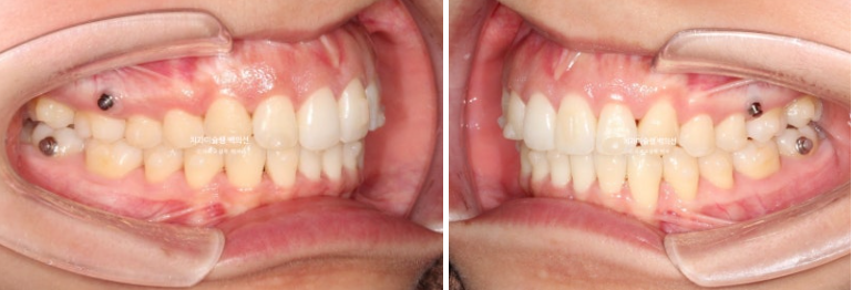 비발치 인비절라인 교정 돌출입 교정 후기 관련 이미지 11