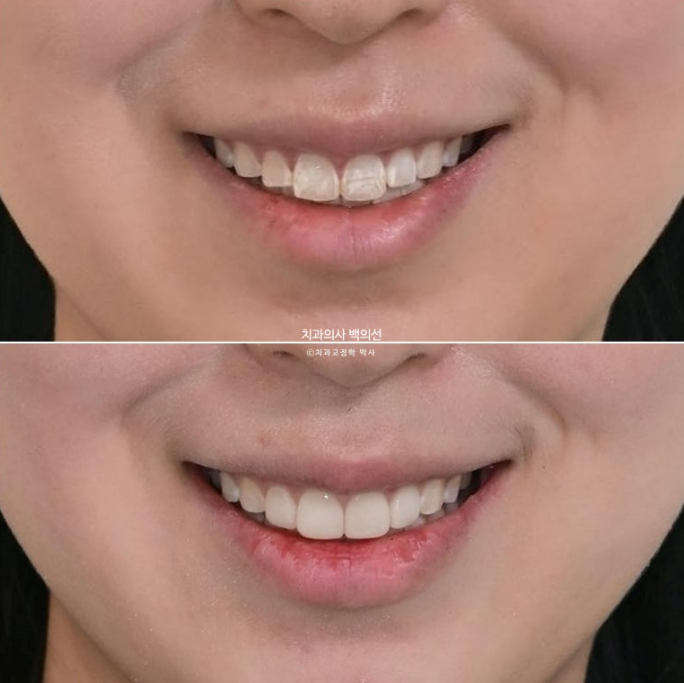 반점치 반상치 치아 하얀 얼룩 치료하기 관련 이미지 8