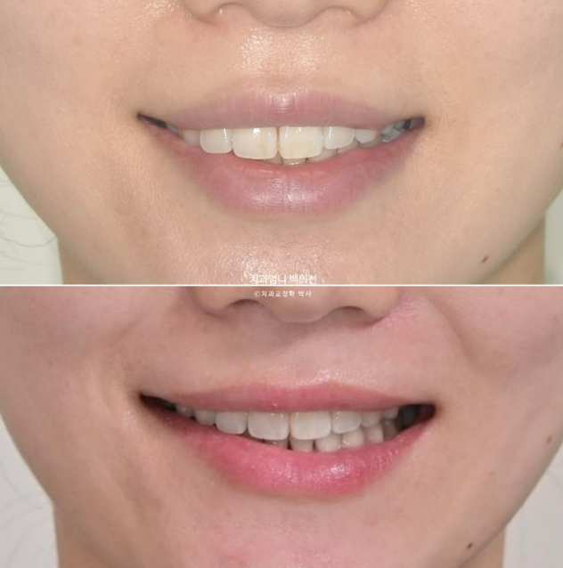 30대 돌출입 발치교정 입술부전증 치료 관련 이미지 16