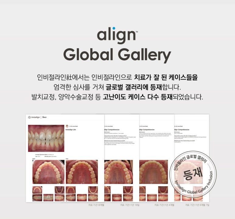 인비절라인 발치교정 가능한가요? 관련 이미지 3