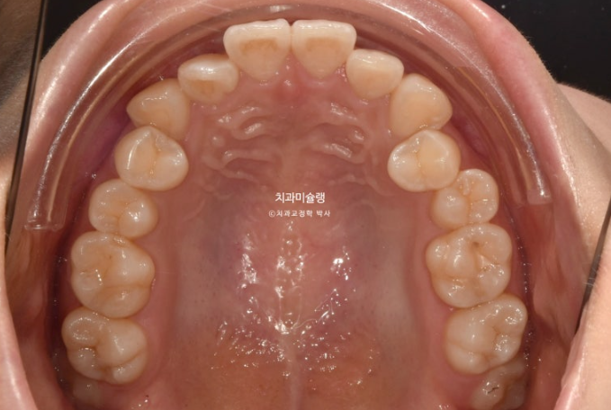 인비절라인 비발치 토끼이빨 교정 덧니 교정 치료기간 1년 8개월 관련 이미지 4