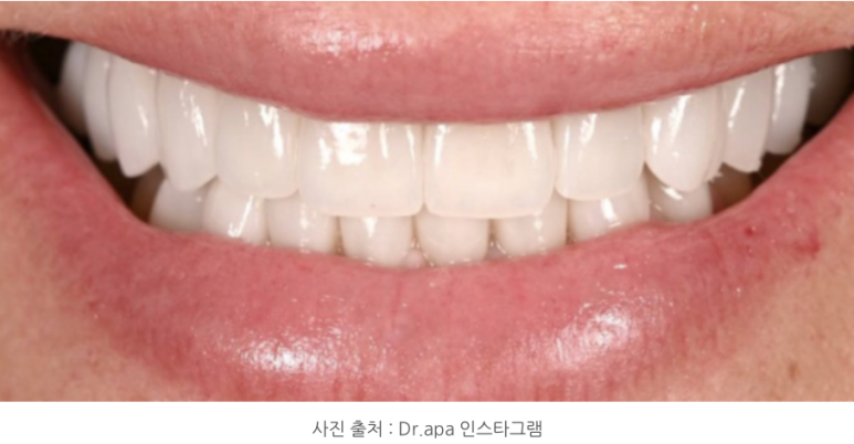 라미네이트 하고 후회하는 경우와 만족하는 경우의 차이 관련 이미지 6