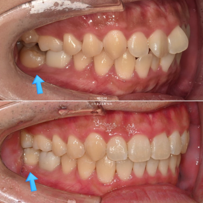 가위교합 나비치아 미니스크류 덧니 교정 인비절라인 라이트 관련 이미지 21