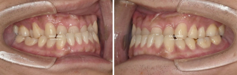 30대 주걱턱 비수술 비발치 교정 후기 관련 이미지 3