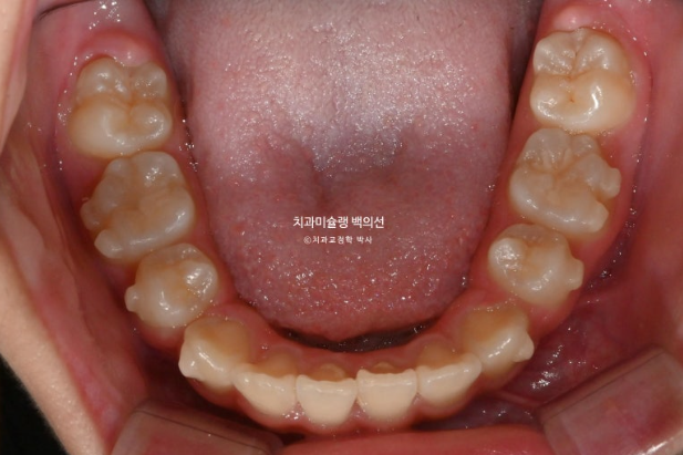 돌출입 무턱 인비절라인 발치교정 덧니 치료기간 1년 11개월 관련 이미지 9