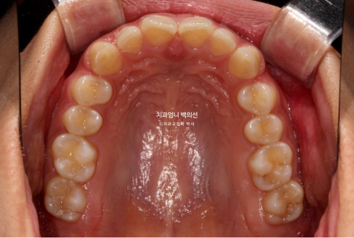 과개교합 옥니 거미스마일 교정 인비절라인 라이트 잇몸성형 후기 관련 이미지 4