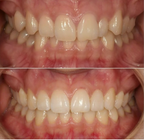 급속 교정 앞니부분교정 치료 무삭제 라미네이트 후기 관련 이미지 13