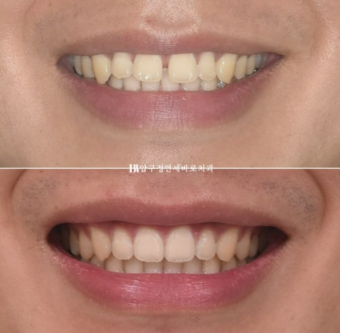 Can Invisalign Fix a Gap Between the Front Teeth? ๐ฎ A Real 9-Month Case Finished Without Remaking Aligners image 13