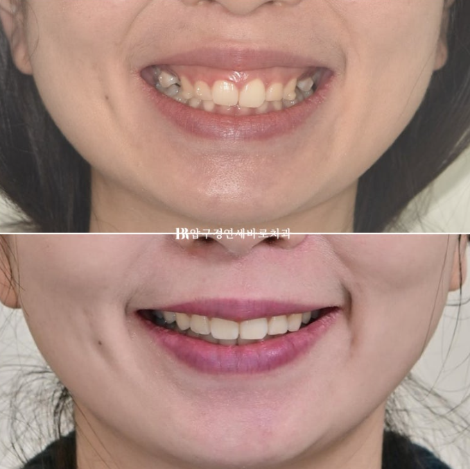 Does Invisalign Prevent Root Movement? Before-and-After Comparison of Extraction Treatment for Protruding Lips image 13