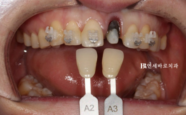 임플란트 없이 자연치아 살리기 앞니 부분교정 보철교정 관련 이미지 4