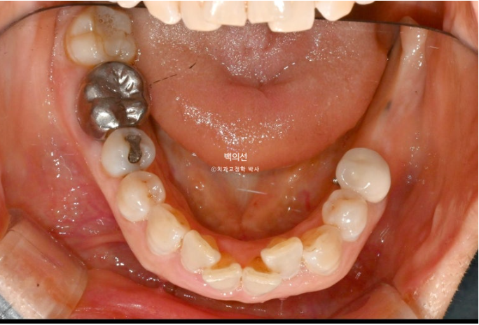 40대 인비절라인 라이트 앞니 돌출 과개교합 덧니 교정 후기 관련 이미지 6