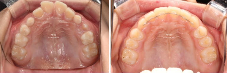 인비절라인퍼스트 어린이 투명교정 과개교합 덧니 악궁확장 돌출 관련 이미지 18