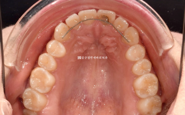 Before and After Non-Prep Veneers: Improving Gaps Between the Front Teeth and the Smile Line Together image 6