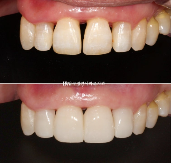 A 60s Patient’s Orthodontic Treatment Review | A Case Combining Partial Orthodontics for the Front Teeth After Periodontitis Treatment with No-Prep Veneers image 6