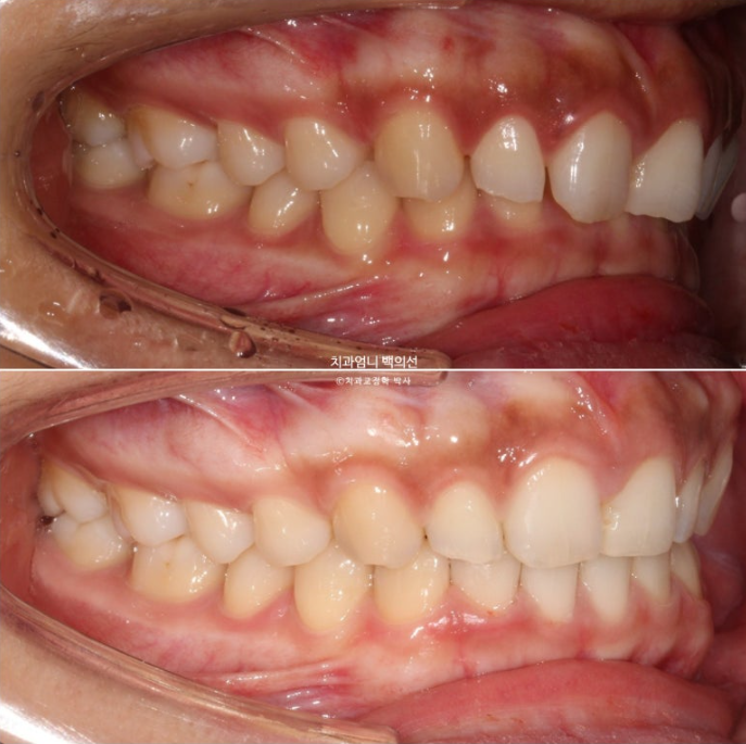과개교합 옥니 거미스마일 교정 인비절라인 라이트 잇몸성형 후기 관련 이미지 17