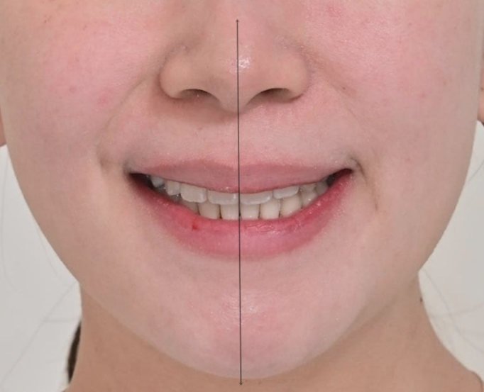 비발치 교정 덧니 인비절라인 교정 절단교합 반대교합 치료기간 1년 6개월 관련 이미지 17