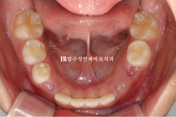 어린이 무턱교정 인비절라인 퍼스트 실제 치료 후기 관련 이미지 19