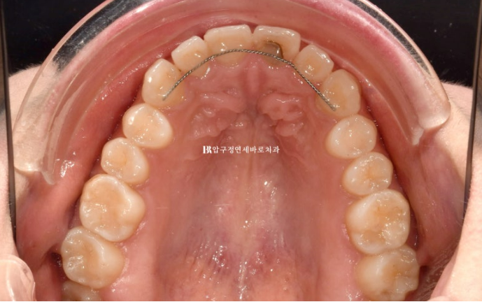 스마일라인 개선 무삭제 라미네이트 실제 두께 ? 관련 이미지 6
