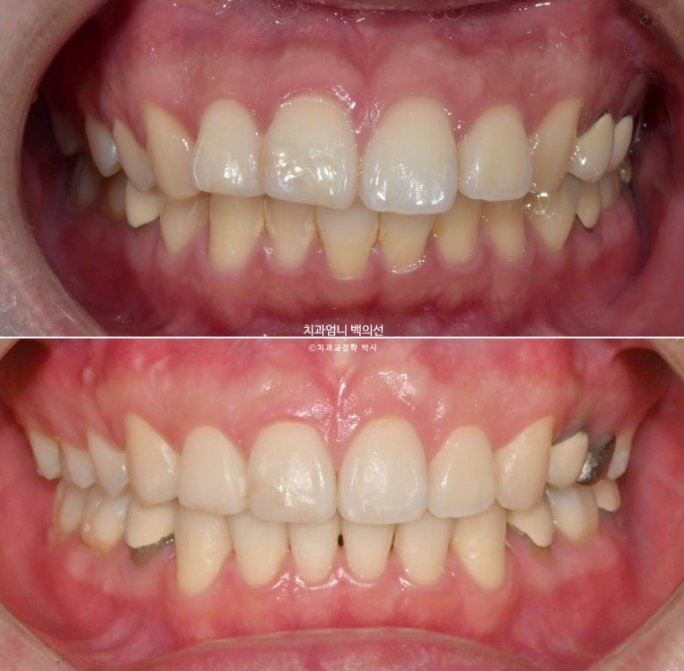 돌출입 발치 교정 인비절라인 후기 미니스크류 관련 이미지 18