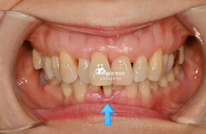 50대 치아교정 중년 발치교정 블랙트라이앵글 치료 후기 관련 이미지 2