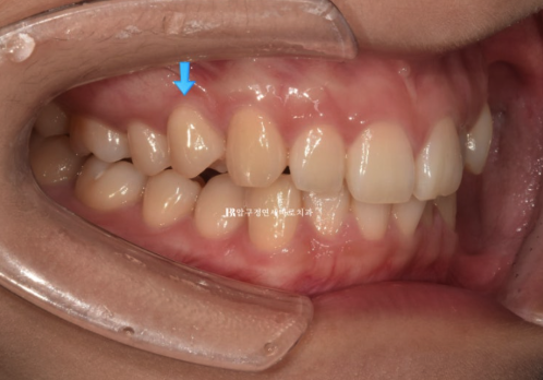 앞니 부분교정은 어떤 경우에 가능한가요? 단기 앞니 부분교정 왜소치 치료 무삭제 라미네이트 관련 이미지 5