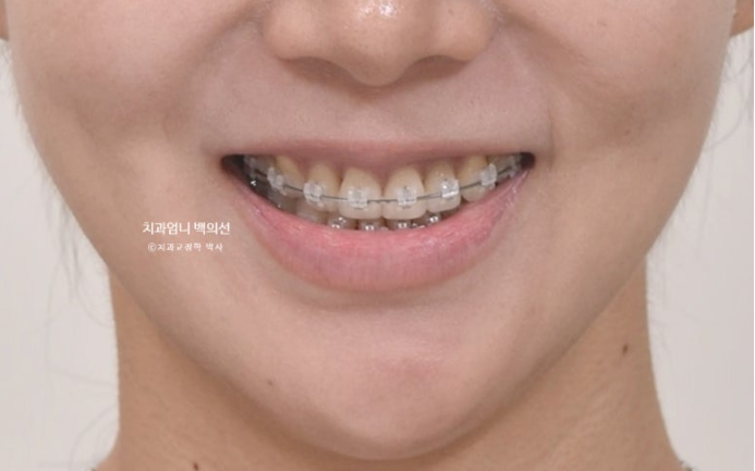 옥니 역교정 재교정 무턱 교정 치료기간 1년 10개월 관련 이미지 10