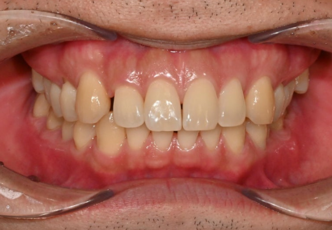 가위교합 벌어짐 중심선 과개교합 인비절라인 라이트 교정 관련 이미지 2