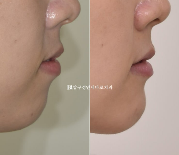 비발치인데 돌출입 거미스마일까지 개선? 얼굴이 작아지는 클리피씨 교정 관련 이미지 12