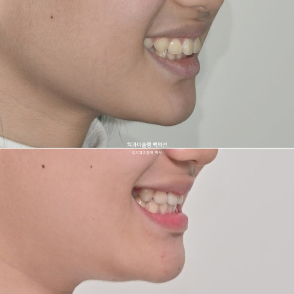 덧니 돌출입 발치교정 상악만 2개 편악 발치 클리피씨 입술부전증 치료 관련 이미지 1