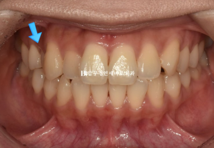 Invisalign Lite Treatment for Crossbite, Rabbit Teeth, and Protruding Front Teeth Correction image 2