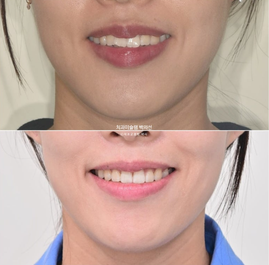 인비절라인 돌출입 발치교정 임플란트 없이 사랑니 대체 관련 이미지 27