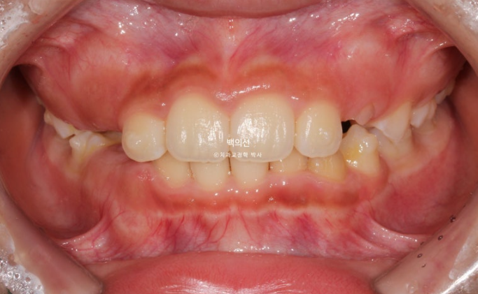 인비절라인퍼스트 어린이 투명교정 과개교합 덧니 악궁확장 돌출 관련 이미지 7