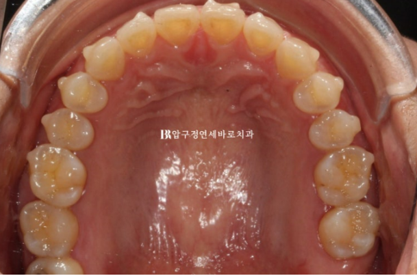 Can Gaps Between the Front Teeth Be Treated with No-Prep Veneers Alone? A Real Case Completed with Gelami After Invisalign Lite image 9