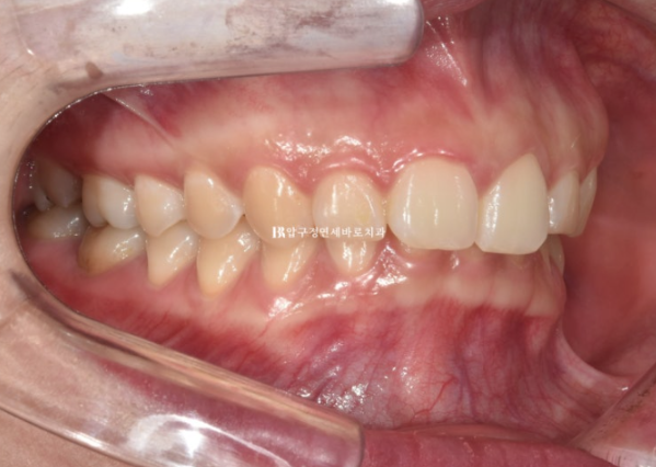 Can't Invisalign Move the Roots? An Actual Case of Extraction Treatment for Protruding Mouth at a Gangnam Orthodontic Clinic image 2